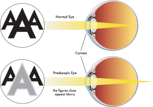 presbiopia occhio